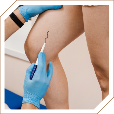 Imagem Escleroterapia